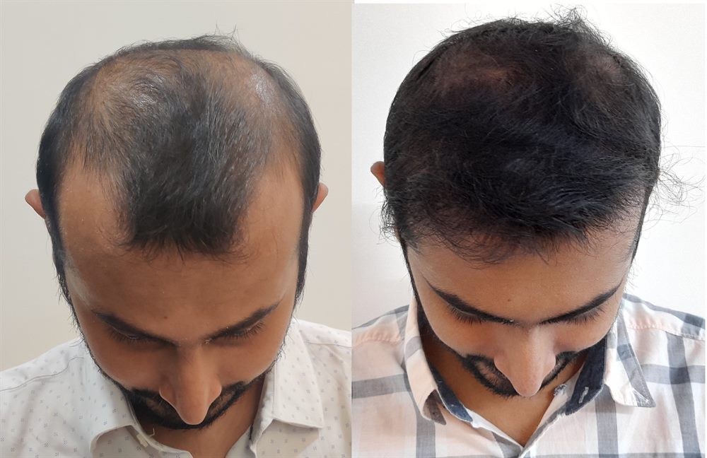 Hair transplant patient result for density refinement