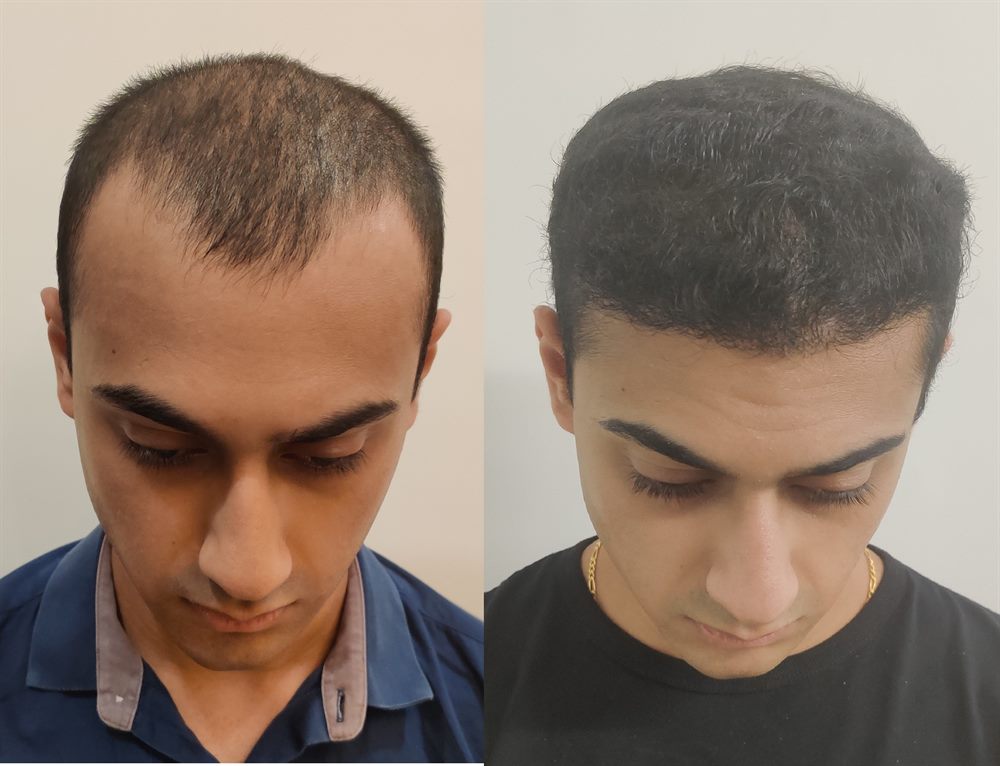 Hairline restoration patient result from Mumbai clinic