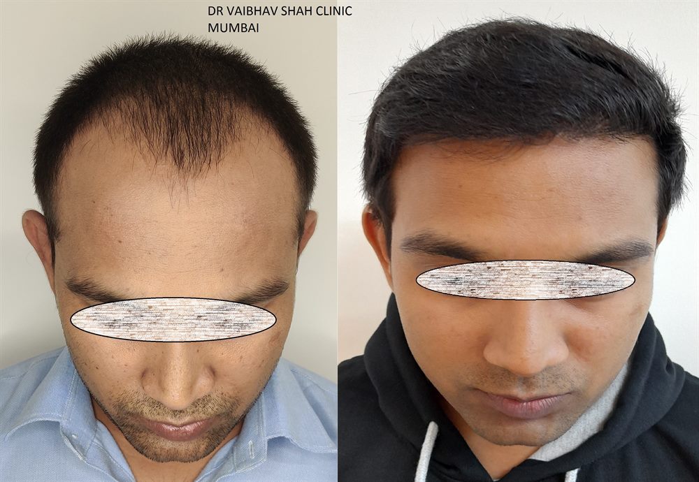 High density hair transplant patient result
