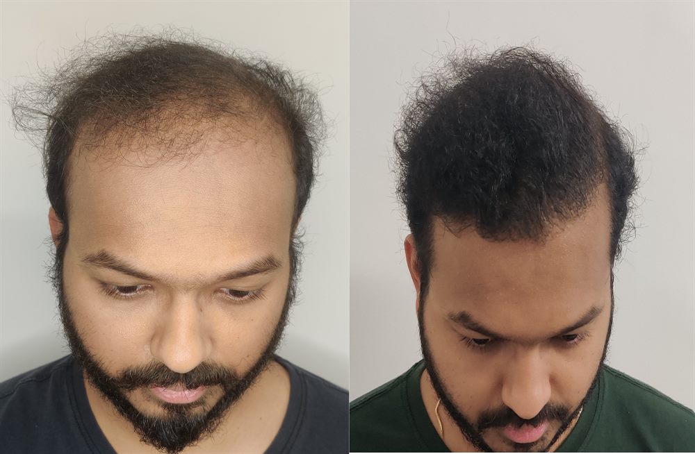 Hair transplant before after style clinical result